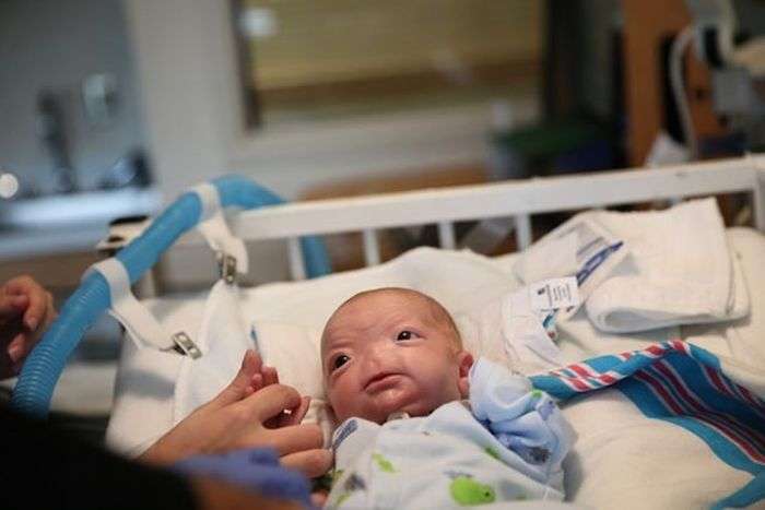 Елі Томпсон – милий 3-місячний хлопчик з відсутнім носом (12 фото)