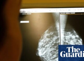 KI steigert die Früherkennung von Brustkrebs um 12 %, wie eine wegweisende Studie zeigt