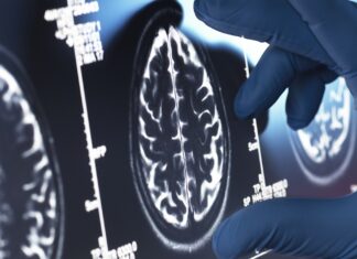 Viagra, Shingles Vaccine, and ALS Drug Ranked as Top Alzheimer’s Treatment Candidates