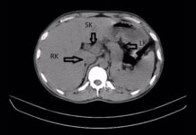 Чоловік виявив третю нирку, звертаючись за лікуванням при інфекції сечовивідних шляхів.