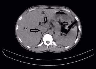 Homem descobre terceiro rim enquanto procura tratamento para ITU