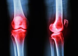 Les médicaments GLP-1 pourraient-ils offrir une nouvelle voie pour le traitement de l’arthrite ?