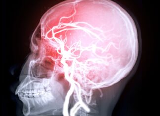 Micro-brain damage linked to weak heart pump may foreshadow memory loss